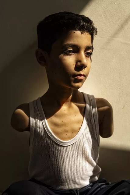 World Press Photo Genova Bambino con le braccia mutilate